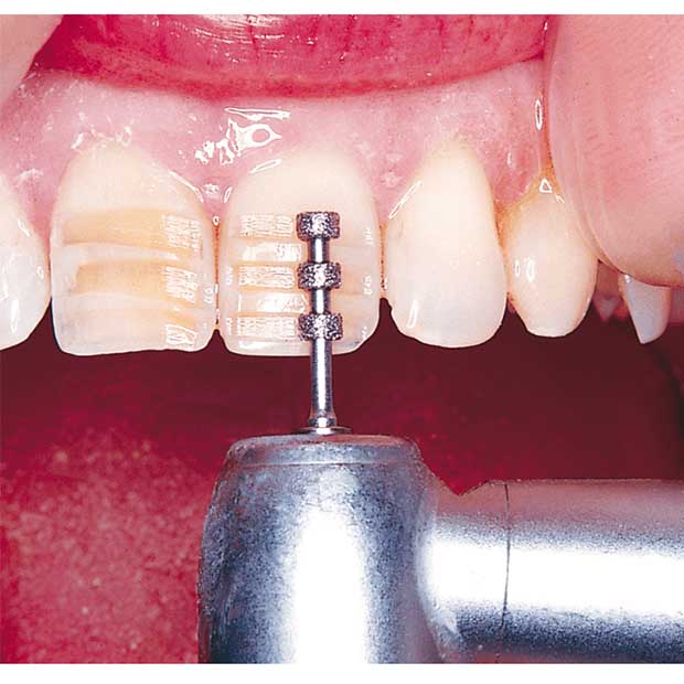 فرز الماسی توربین سر موجدار (لمینیت)-6 - 3