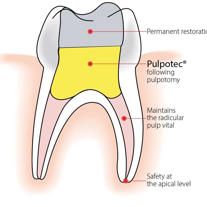 پالپوتک پی دی - 5